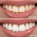 Teeth-Whitening-Cost-in-Dubai6.jpg