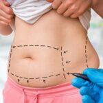 Tummy-Tuck-Surgery-in-Riyadh-8.jpg