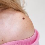 What-is-the-Cost-of-Mole-Removal.jpg