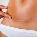 What-scars-remain-after-tummy-tuck-treatment1.jpg