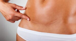 What Is Laser Hair Removal and How Does It Really Work?