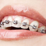 braces-treatment.jpg