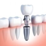 dental-implants.jpeg