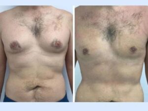 Top Reasons to Consider Gynecomastia in Dubai