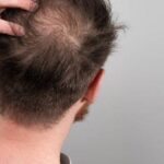 hair-loss.jpg