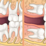 impacted-wisdom-teeth.jpg
