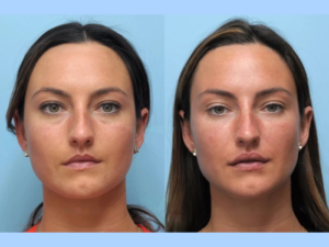Explore the Best Plastic Surgeons in Dubai for Thread Lift Services