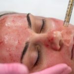 vampire-facelift-facial-at-rn-esthetics_l_1200x800-1170x658.jpg