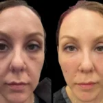 5-Dark-Circles-Treatment.webp
