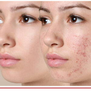 Are Acne Treatments in Dubai Effective for Both Men and Women Equally?