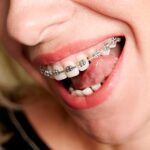 Common-Problems-with-Metal-Braces-and-How-to-Solve-Them.jpg