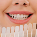 Composite-Veneers-for-Smile-Makeovers-Before-and-After-Results.png