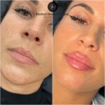 Copy-of-lip-filler-3_11zon.jpg