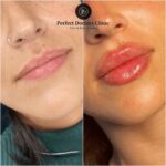 Copy-of-lip-filler-9.jpg