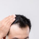 Crown-Hair-Transplant-Cost-in-Dubai.jpg