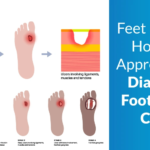 Diabetic-foot-ulcers.png