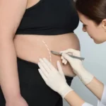 Does-Liposuction-Help-Diabetes.webp
