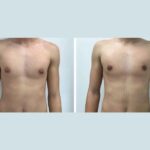 H1-Gynecomastia.jpg