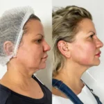 H5-Endolift.webp