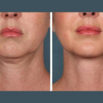H8-PRP-Treatment.jpg