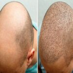 Hair-Transplant-in-Dubai-UAE.jpg