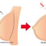 How-Much-Does-Breast-Augmentation-Surgery-Cost-in-Delhi-Latest-Prices.jpg