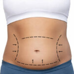Lipo-Abdominoplasty-in-Riyadh-5.jpg