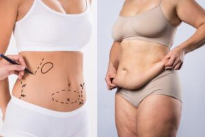 Mini Gastric Bypass Surgery in Islamabad