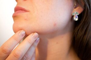 Is Microneedling Better Than Laser Treatments for Acne Scars?