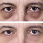 PRP-Injections-for-Under-Eye-Bags-Dubai-.jpg