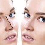 Rhinoplasty.jpg