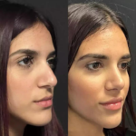 Rhinoplasty-in-Dubai.png