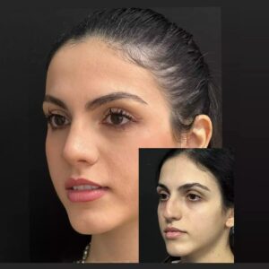 The Growing Demand for Rhinoplasty in Islamabad: Trends and Insights