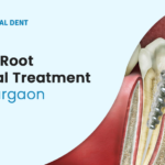 Root-Canal-treatment.png