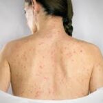 Shingles-symptoms-in-Riyadh-21.jpg