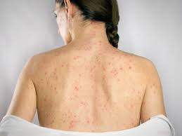 The Most Common and Rare Shingles Symptoms to Be Aware Of