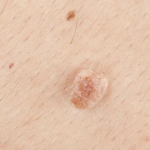 Skin-Tag-Removal-in-Dubai.png