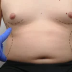 TUMMY-TUCK-ABDOMINOPLASTY.webp