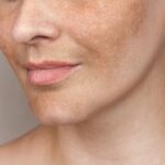 What-Is-the-Best-Dermal-Pigmentation-Treatment.jpg