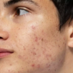 What-Pimples-Treatment-Is-Best-For-Whiteheads.png