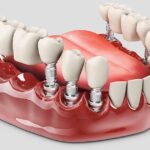 cost-of-dental-implants-chattanooga-tn.jpg