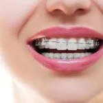 dental-braces-in-islamabad.webp