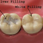 dental-tooth-fillings.gif