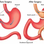 gastric-bypasss.webp