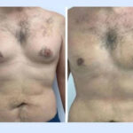gynecomastia-in-dubai-1-1-1.jpg