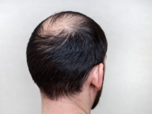 https://tumblrblog.com/do-hair-loss-solutions-help-with-pattern-baldness/