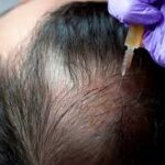 prp-hair-treatment-dubai-sharjah-jumeirah.jpeg