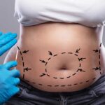 tummy-tuck-in-dubai-1.jpg