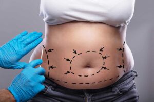Recovery Journey After Tummy Tuck Dubai