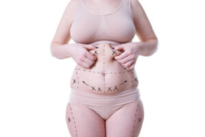 Best Age to Get Lipo Abdominoplasty in Riyadh
